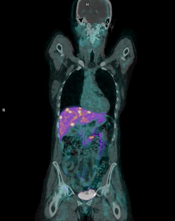 El Reina Sofía usa un nuevo radiofármaco para diagnóstico de tumores neuroendoendocrinos